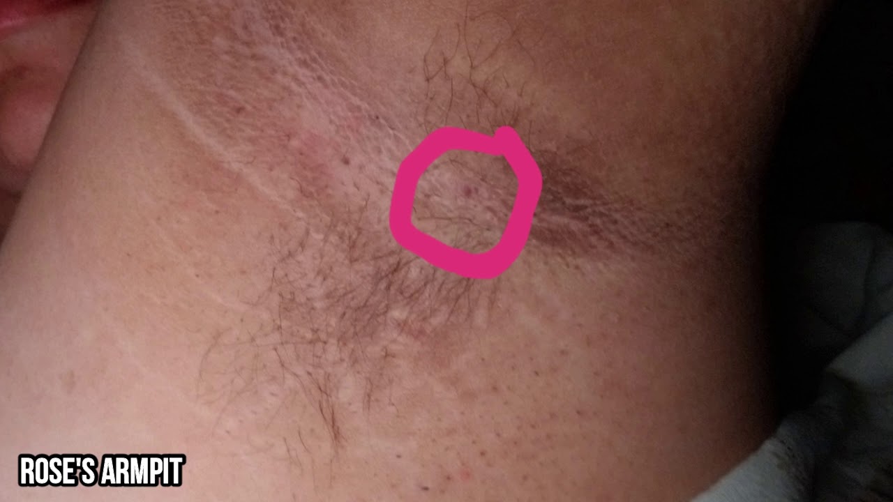 Rose's Mystery Cyst?  What is it?  Pimple Pops & More