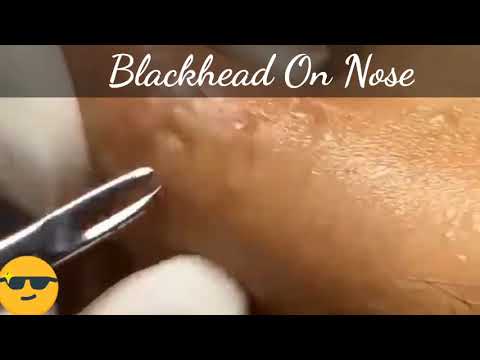 Satisfied Blackhead Removal From Nose | Pimple Popping #shorts #short
