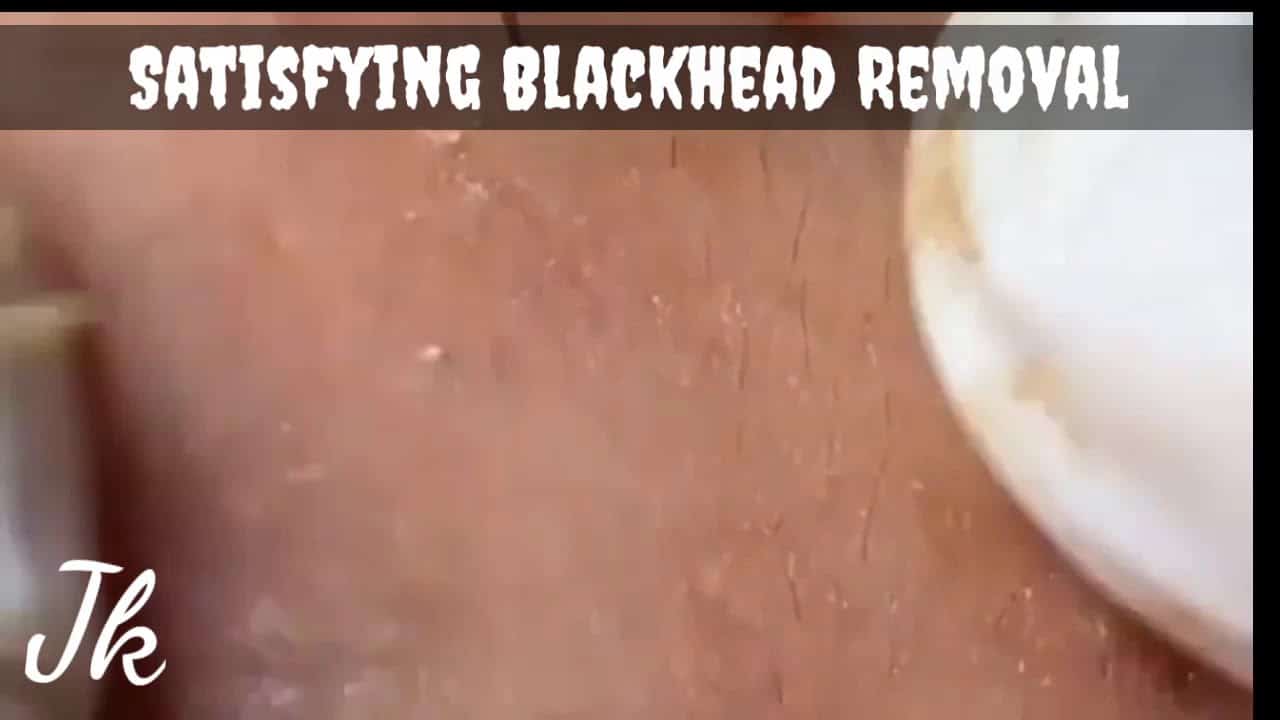 Satisfying and Relaxing Blackhead Removal | Pimple Popping | Pimple Removal #shorts #short