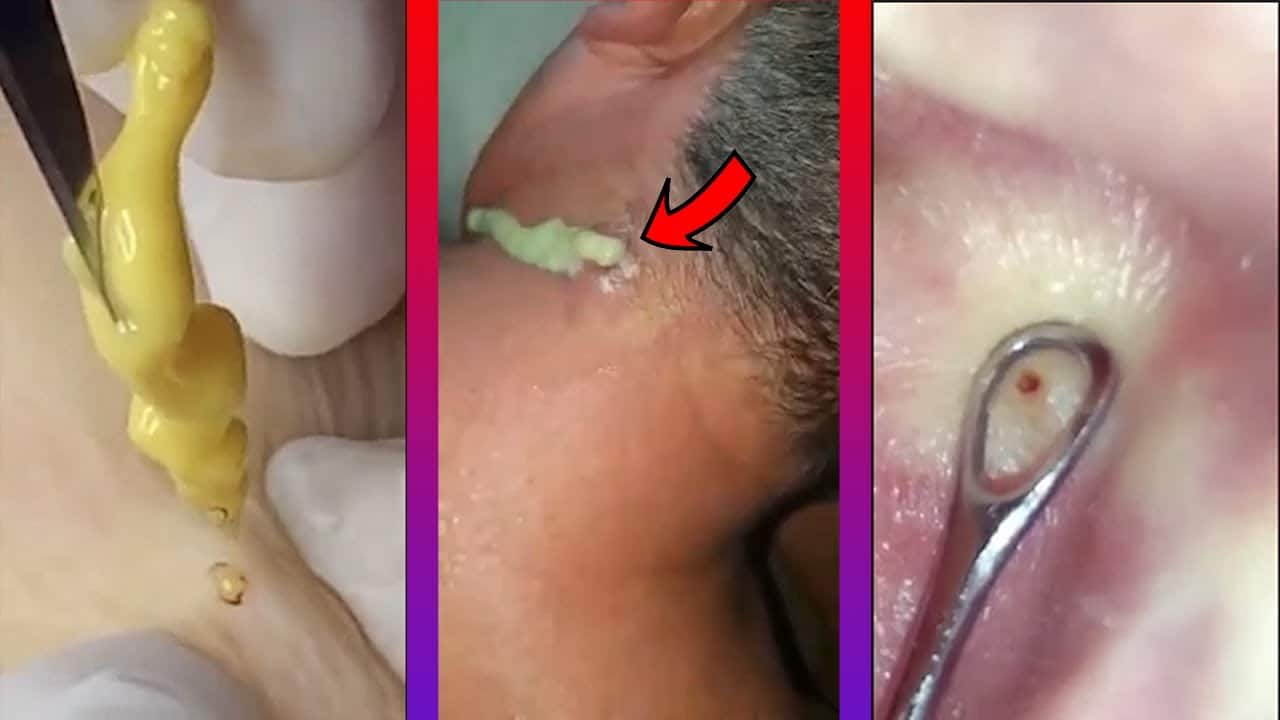 ?Satisfying and relaxing pimple/blackhead popping and removing #5?
