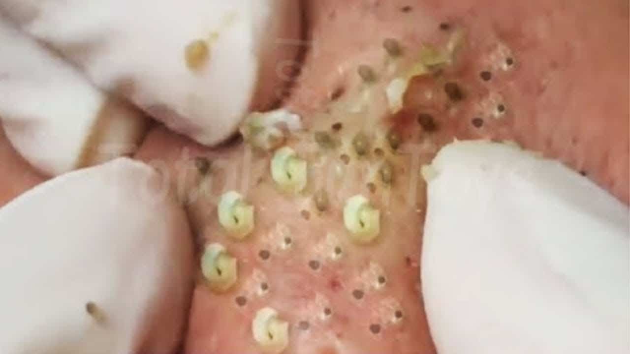 Satisfying blackhead extraction Cystic acne & pimple popping #2