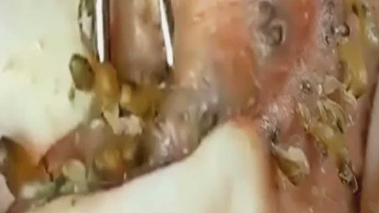 Satisfying blackhead extraction Cystic acne & pimple popping #7