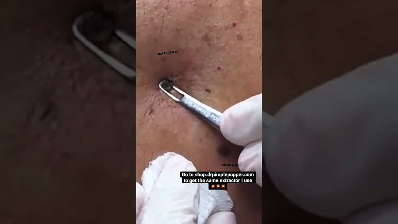 Satisfying Blackhead Extractions w/ Dr. Pimple Popper! 💥 #shorts