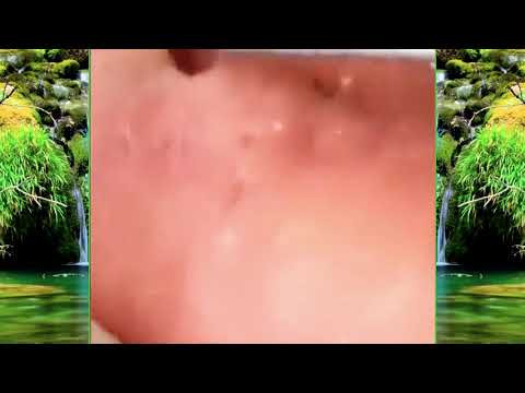 Satisfying Blackhead Removal At Home | Acne Treatment | Pimple Popping #005