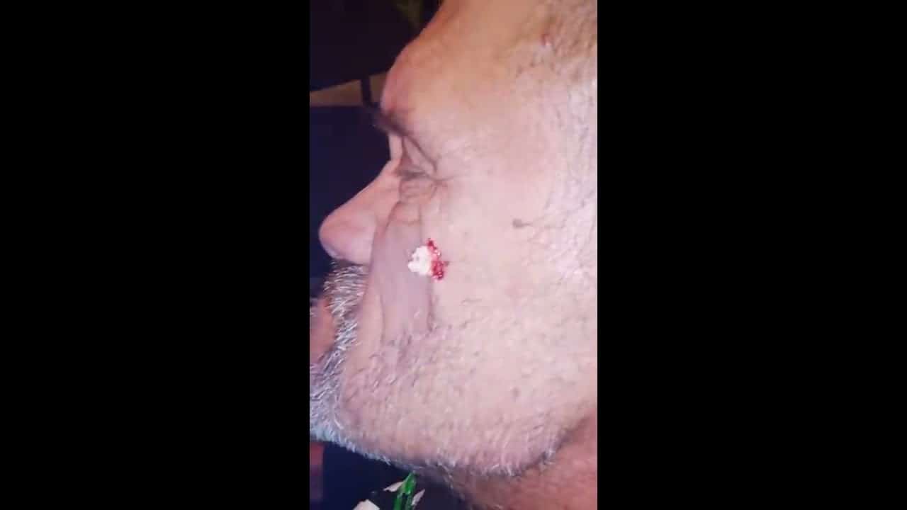 satisfying cyst pop at home
