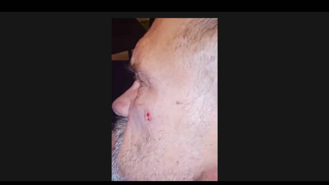 satisfying cyst pop at home