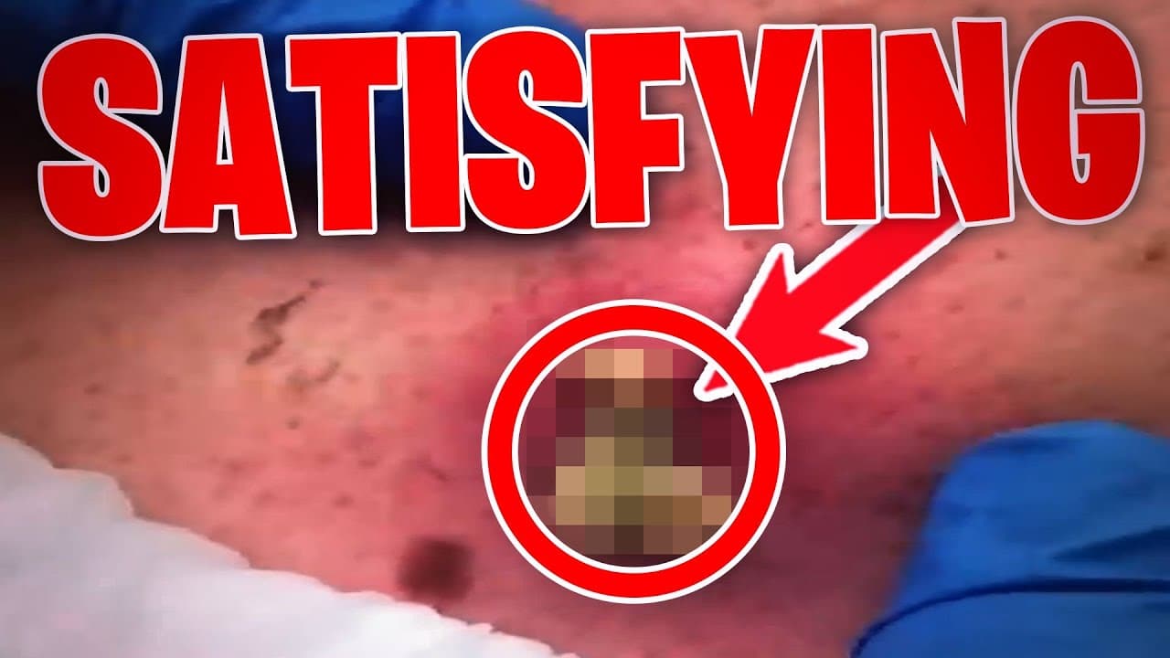 SATISFYING cyst pop – Really GROSS