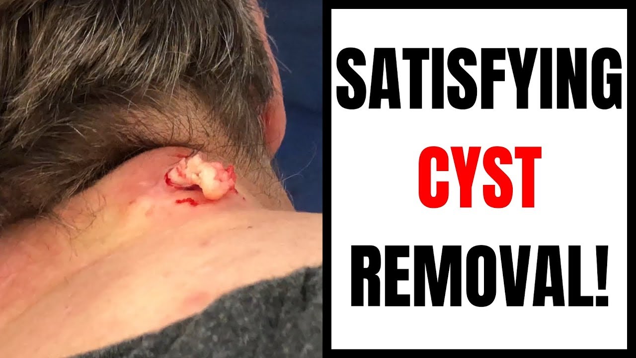 SATISFYING CYST REMOVAL!