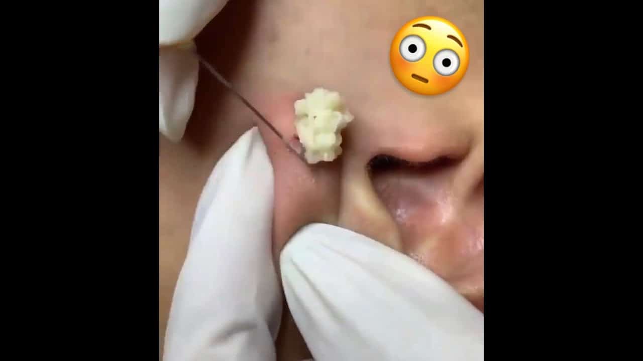 Satisfying Earlobe Pimple Popping | Pimple Popping