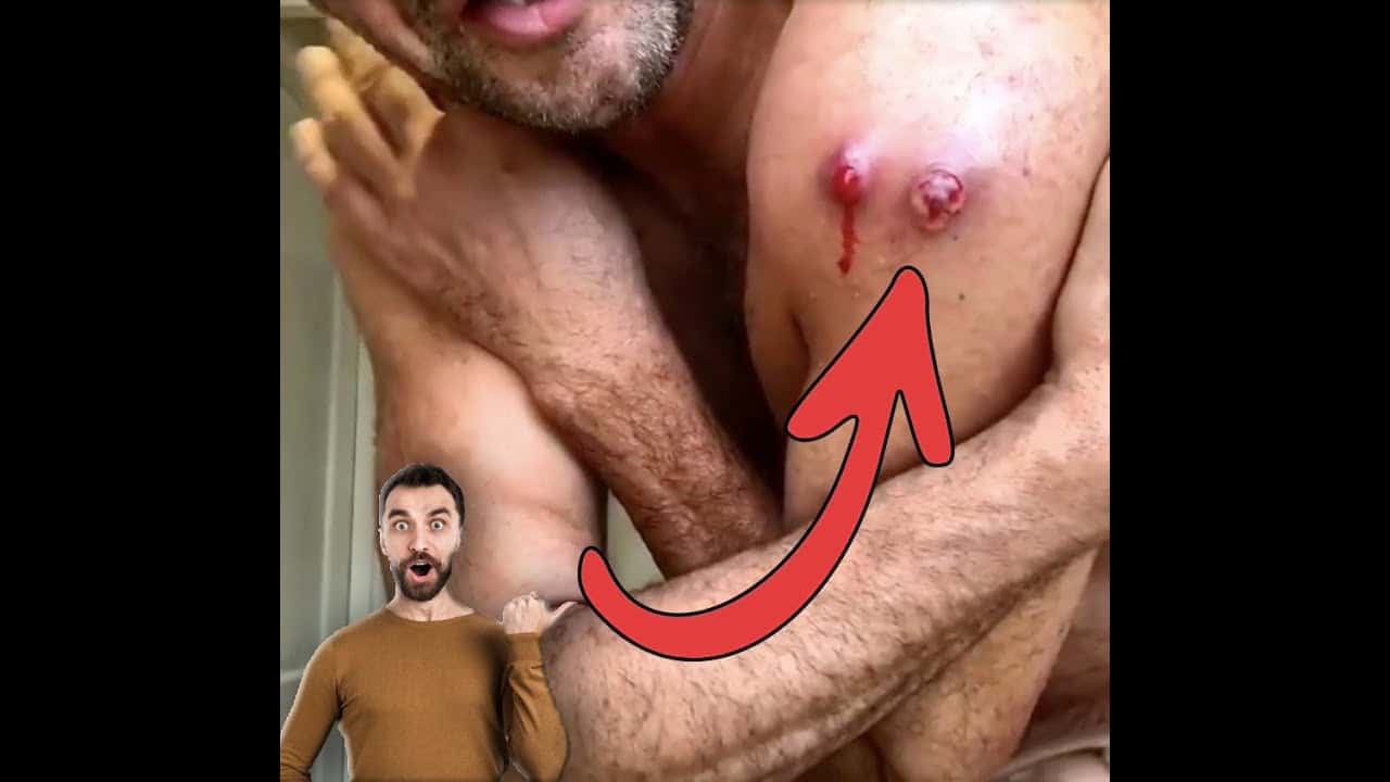 Satisfying huge pimple popping compilation