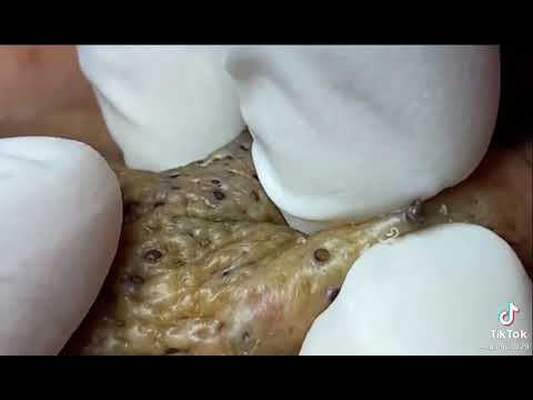 Satisfying nose blackhead removal