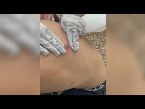 Satisfying Pimple & Cyst popping this week, blackheads, zits , acne treatment compilation