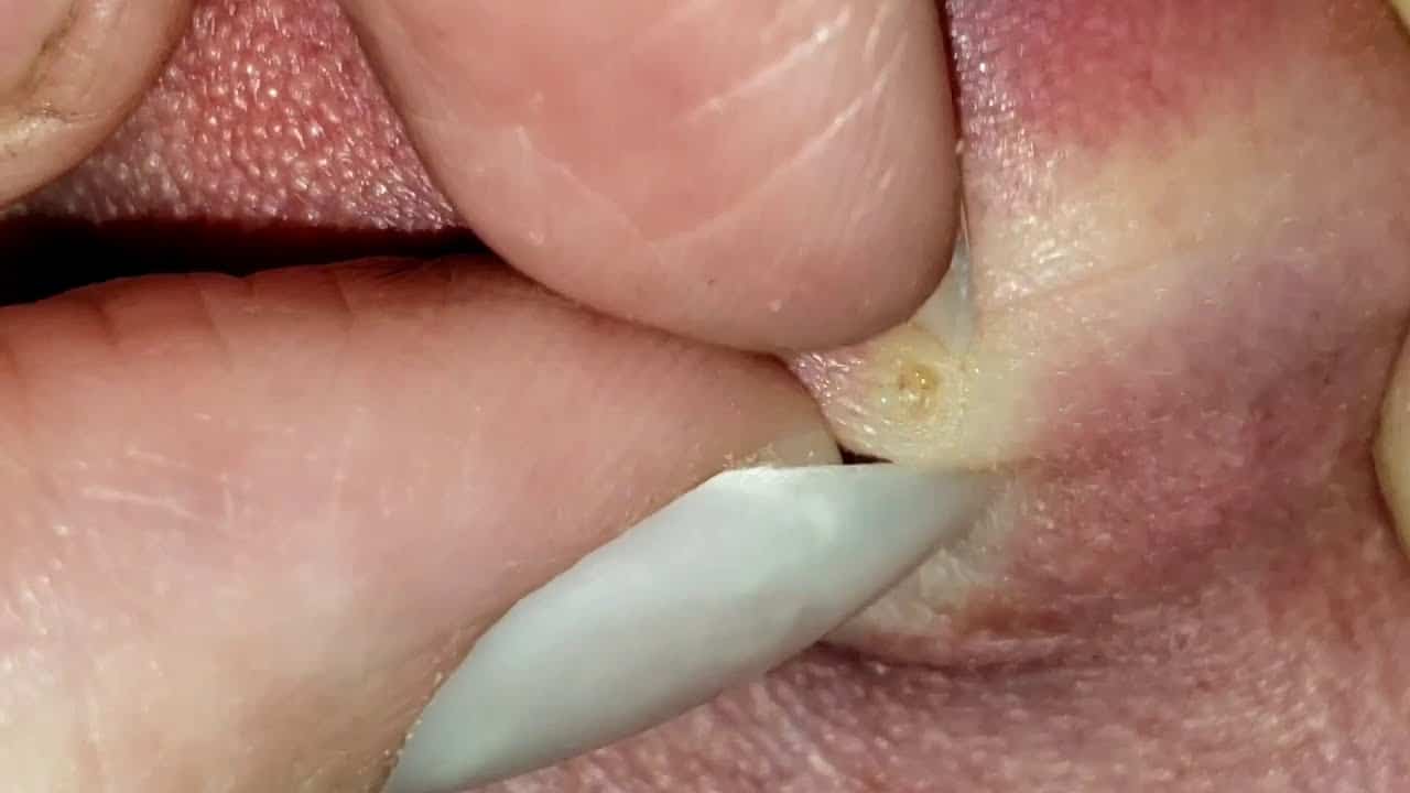 Satisfying Pimple Pop Behind the Ear!