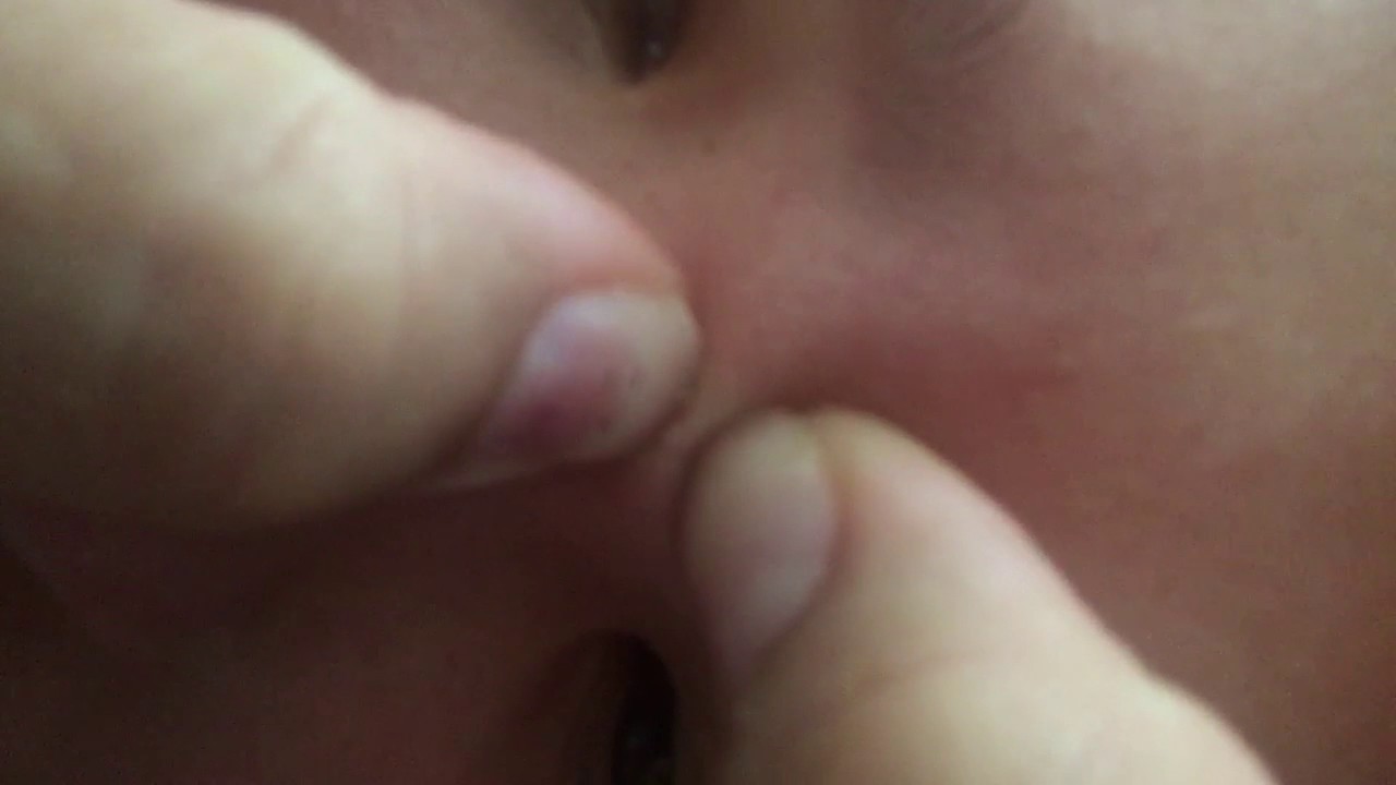 Satisfying pimple popping!!!