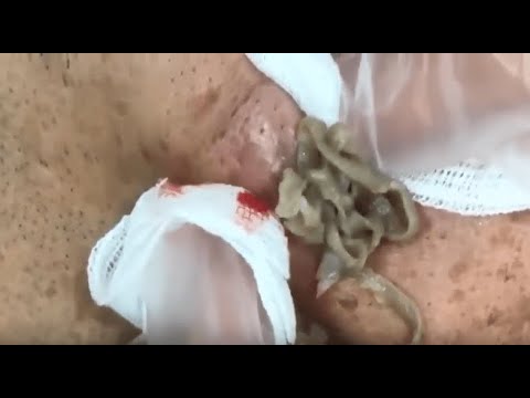 Satisfying Pimple Popping 2019 – Compilation