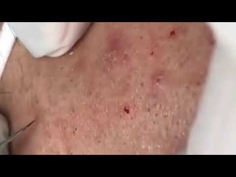 SATISFYING PIMPLE POPPING & BLACKHEAD REMOVAL COMPILATION #18