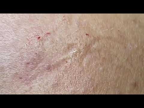 SATISFYING PIMPLE POPPING & BLACKHEAD REMOVAL COMPILATION #12