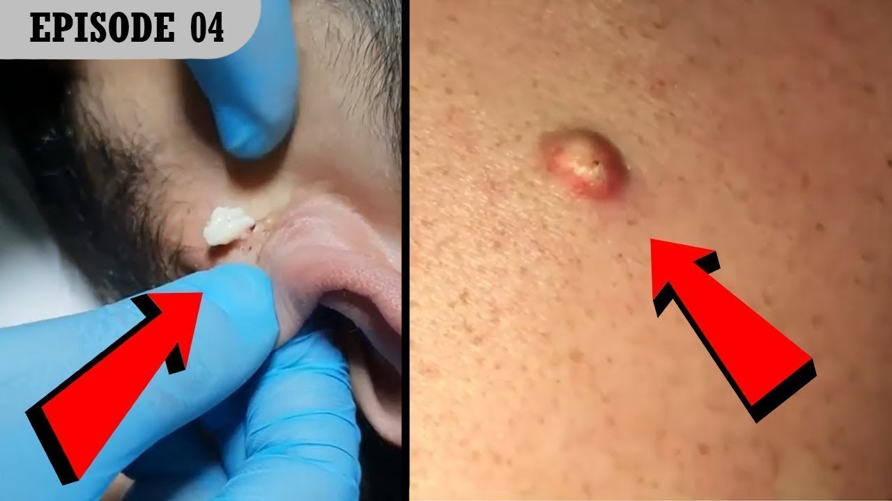 Satisfying Pimple Popping & Blackheads Removing 2019 | Compilation #4