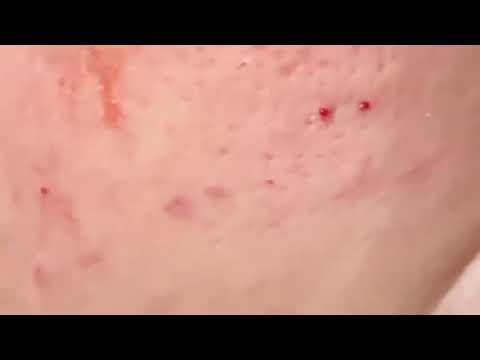 SATISFYING PIMPLE POPPING & BLACKHEAD REMOVAL COMPILATION #4