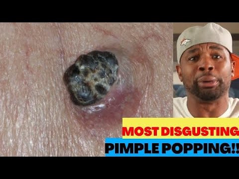 Satisfying Pimple Popping Compilation Part 7