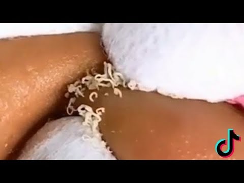 Satisfying pimple popping compilation video 2021 | satisfying background music| pimple popping video