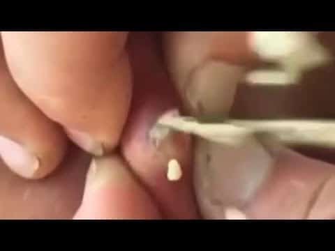 Satisfying pimple popping compilation video 2020 | satisfying background music |