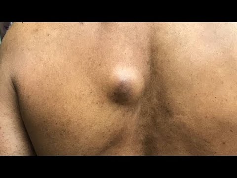 Satisfying pimple popping compilation video 2020 | satisfying background music | pimple popping
