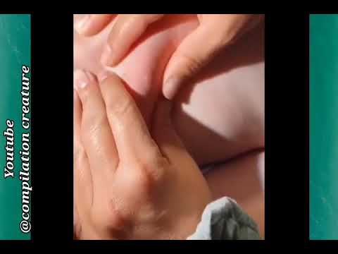 Satisfying pimple popping compilation video 2021 | satisfying background music | pimple popping