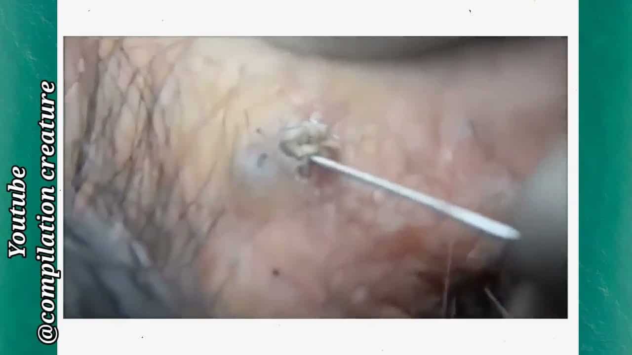 Satisfying pimple popping compilation video 2021 | satisfying background music | pimple popping