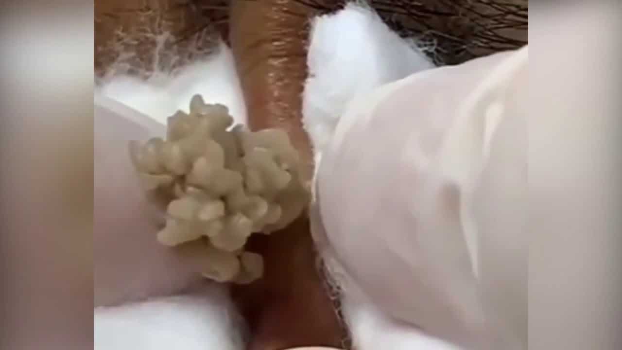 Satisfying Pimple Popping Video | Extraction | Blackhead | Skincare