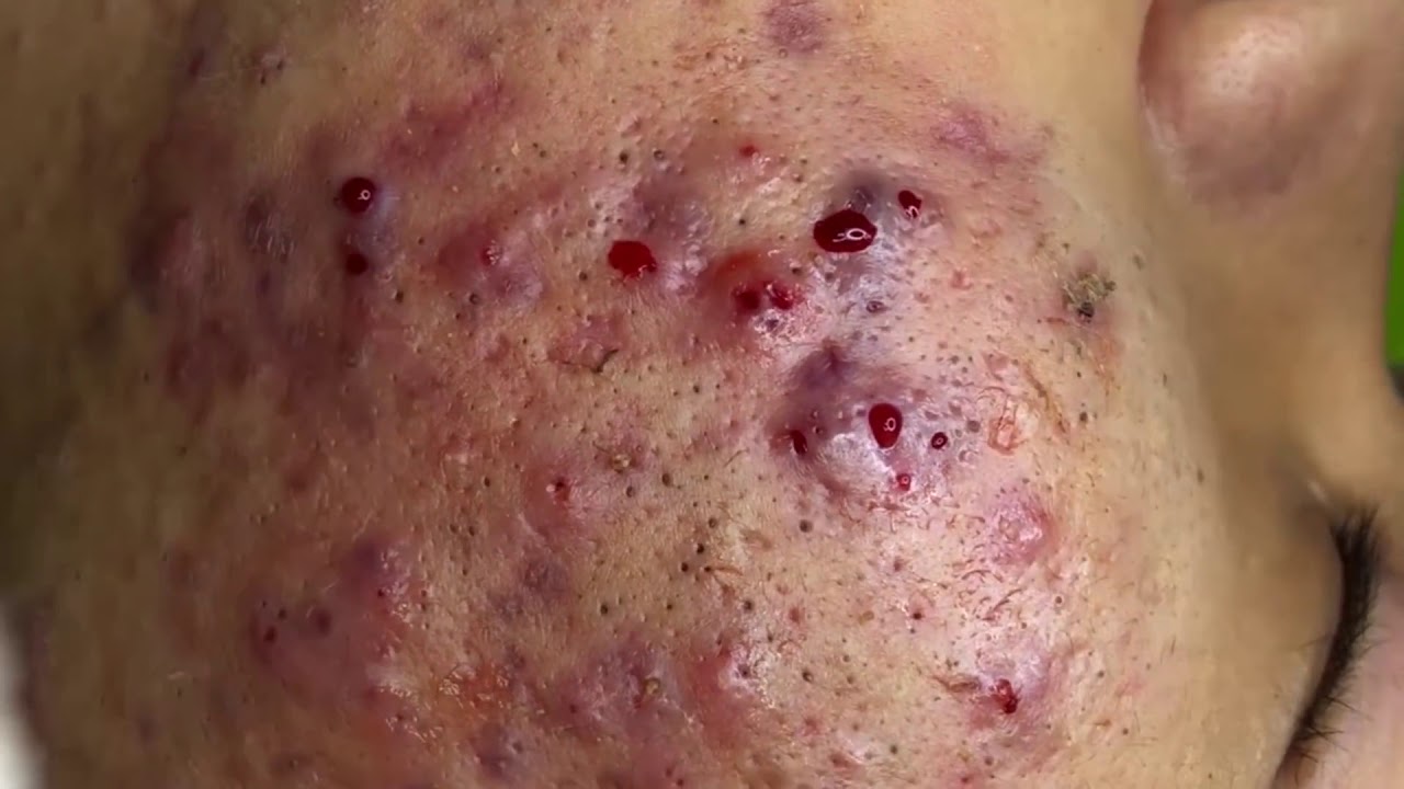 Satisfying popping pimples Acne Treatment Video with Relaxing Music (Better Quality)
