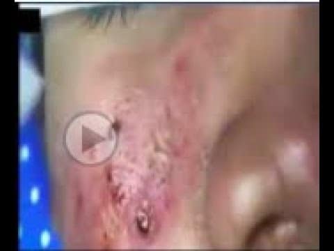 #Satisfying Unbelievable Big Pimples Popping And Blackheads 2021 Face pimples Popping #missblackhead