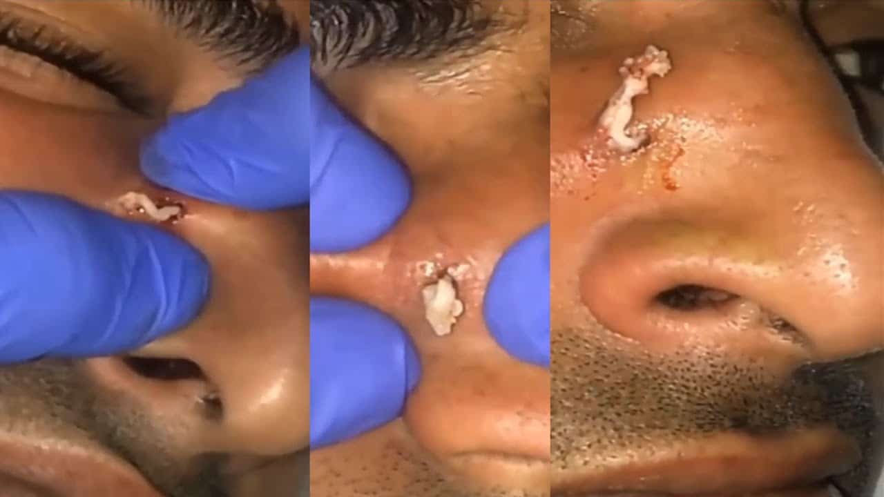 Satisfying Unbelievable Big Pimples Popping And Blackheads 2021 Face pimples Popping #missblackhead