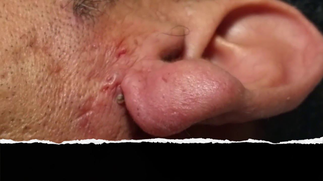 Satisfying video asmr, pimple pop, doctor, make up, extract blackhead, white blackhead