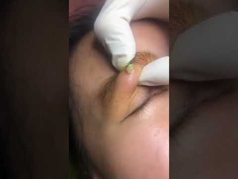 Satisfying Videos | Pimple popping – Acne – Blackheads & Cyst Compilation #38