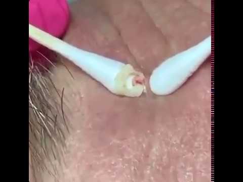 Satisfying Videos | Pimple popping – Acne – Blackheads & Cyst Compilation #37