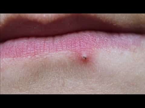 Satisfying Videos | Pimple popping – Acne – Blackheads & Cyst Compilation #36