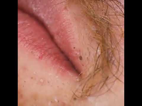 Satisfying Videos | Pimple popping – Acne – Blackheads & Cyst Compilation #52