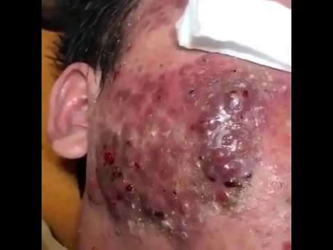 Satisfying Videos | Pimple popping – Acne – Blackheads & Cyst Compilation #7