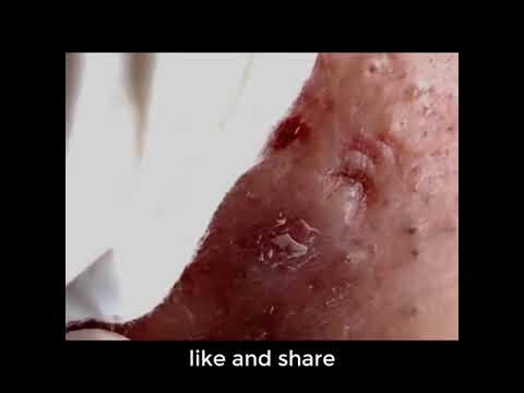Satisfying Videos | Pimple popping – Acne – Blackheads & Cyst Compilation #51