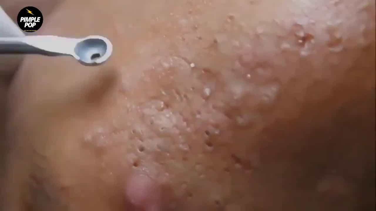 Satisfying Videos | Pimple popping – Acne – Blackheads & Cyst Compilation #47