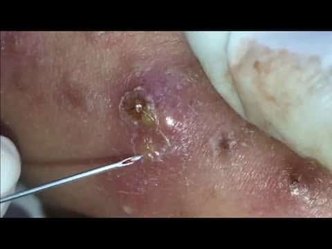 Satisfying Videos | Pimples Popping – Blackheads – Acne & Cysts #118