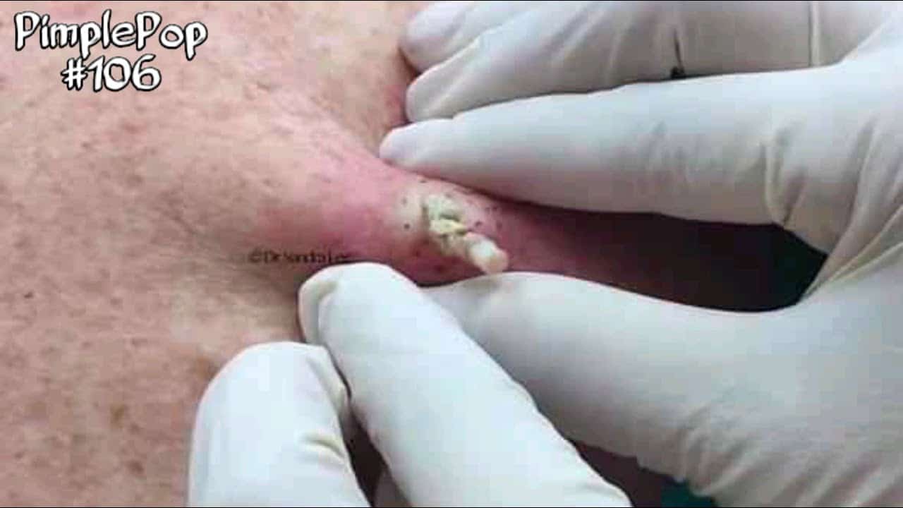 Satisfying Videos | Pimples Popping – Blackheads – Acne & Cysts Compilation #106