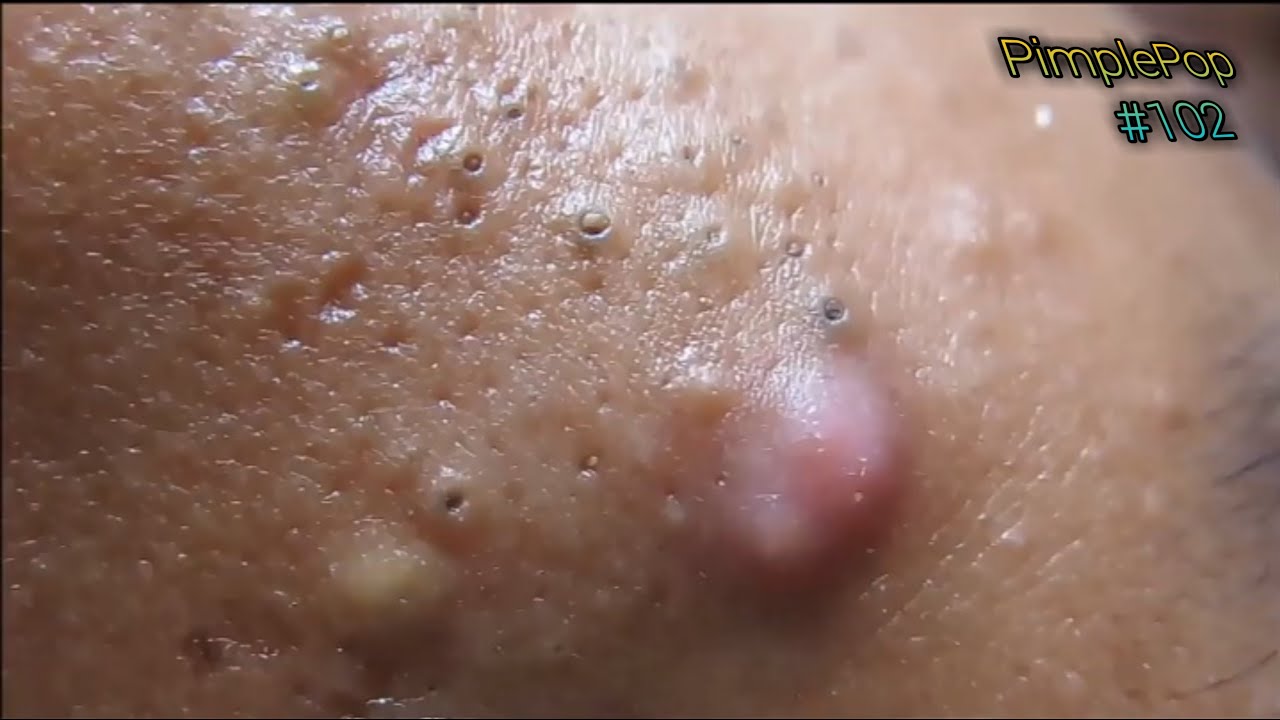 Satisfying Videos | Pimples Popping – Blackheads – Acne & Cysts Compilation #102