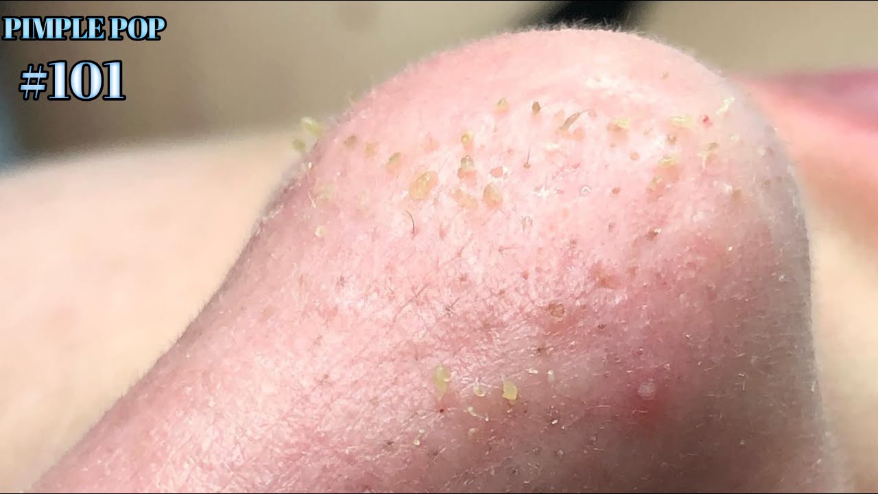 Satisfying Videos | Pimples Popping – Blackheads – Acne & Cysts Compilation #101