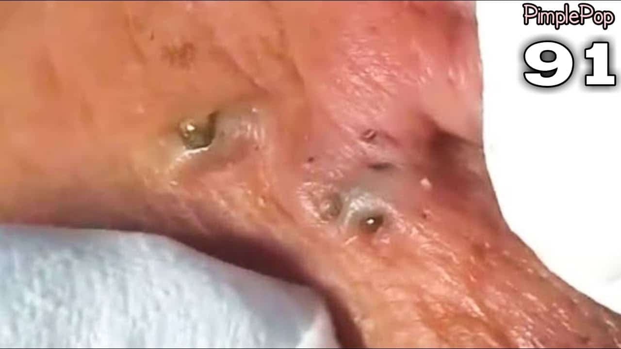 Satisfying Videos | Pimples Popping – Blackheads – Acne & Cysts Compilation #91