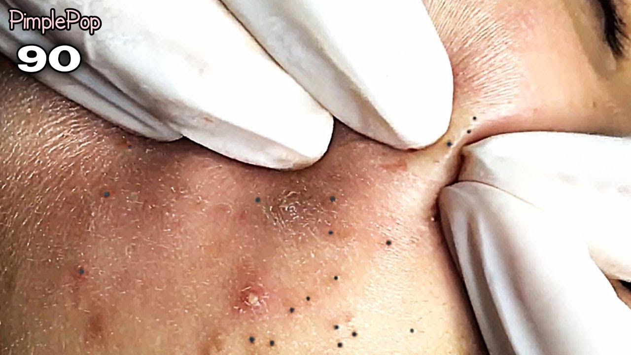 Satisfying Videos | Pimples Popping – Blackheads – Acne & Cysts Compilation #90