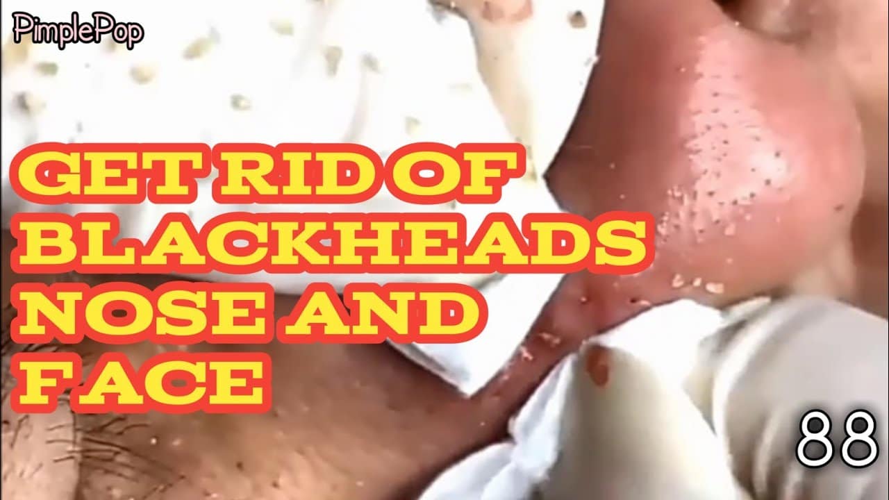 Satisfying Videos | Pimples Popping – Blackheads – Acne & Cysts Compilation #88