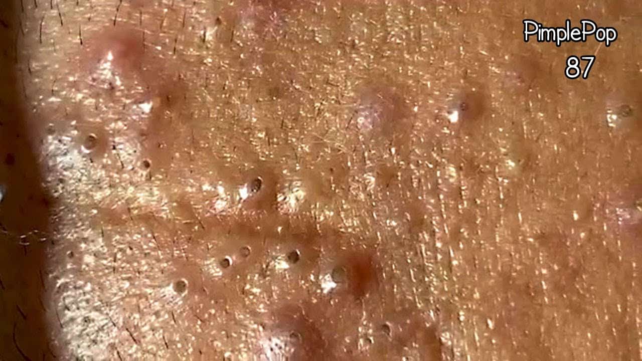 Satisfying Videos | Pimples Popping – Blackheads – Acne & Cysts Compilation #87