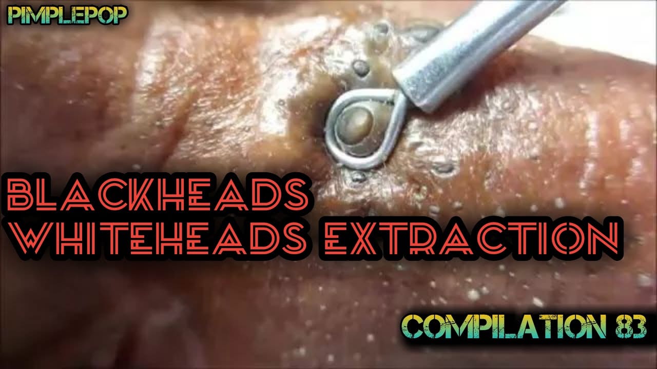 Satisfying Videos | Pimples Popping – Blackheads – Acne & Cysts Compilation #83